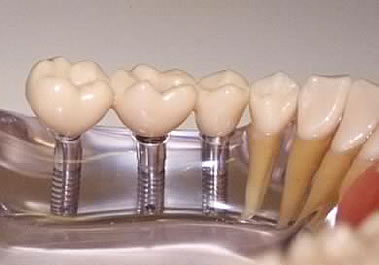 стоимость протезирования зубов и цены на зубные протезы